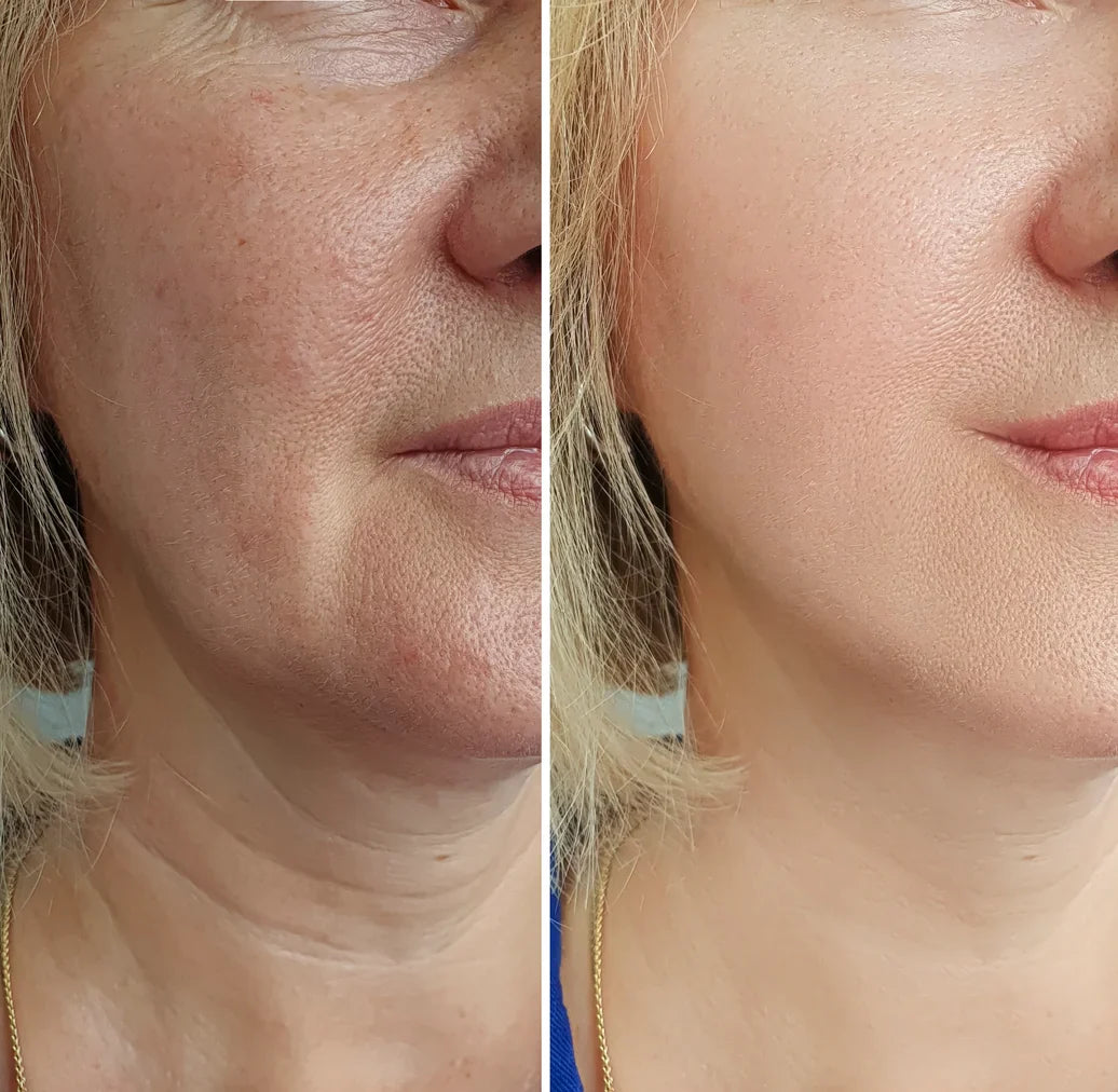 Tresiore infusion par micro-aiguilles