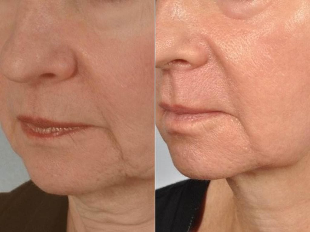 Tresiore microneedle infusion