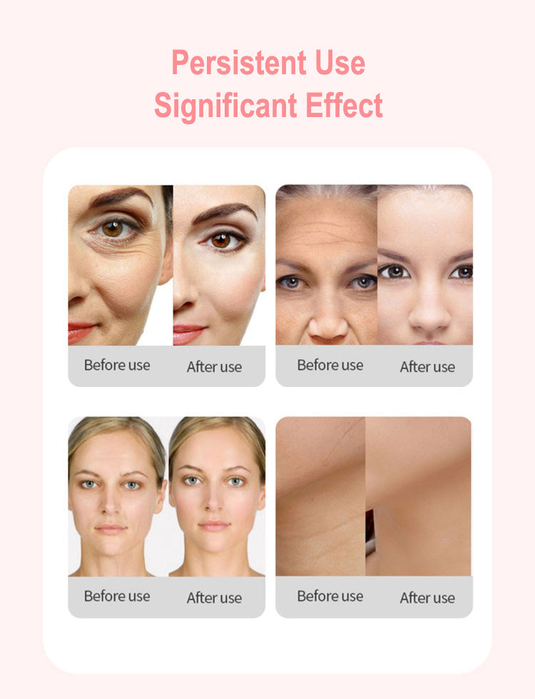 Professionele Hifu Beauty Machine