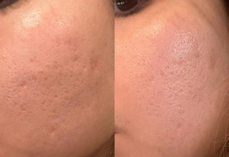 Infusão microneedle Tresiore