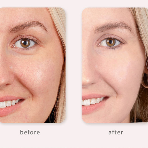Hifu FacialDefy 3.0 Lite