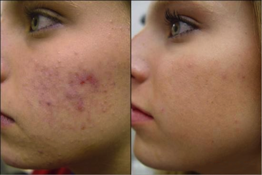 Tresiore infusion par micro-aiguilles