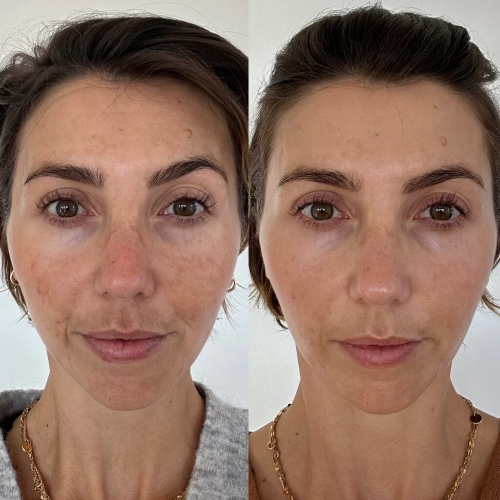 Tresiore microneedle infusion